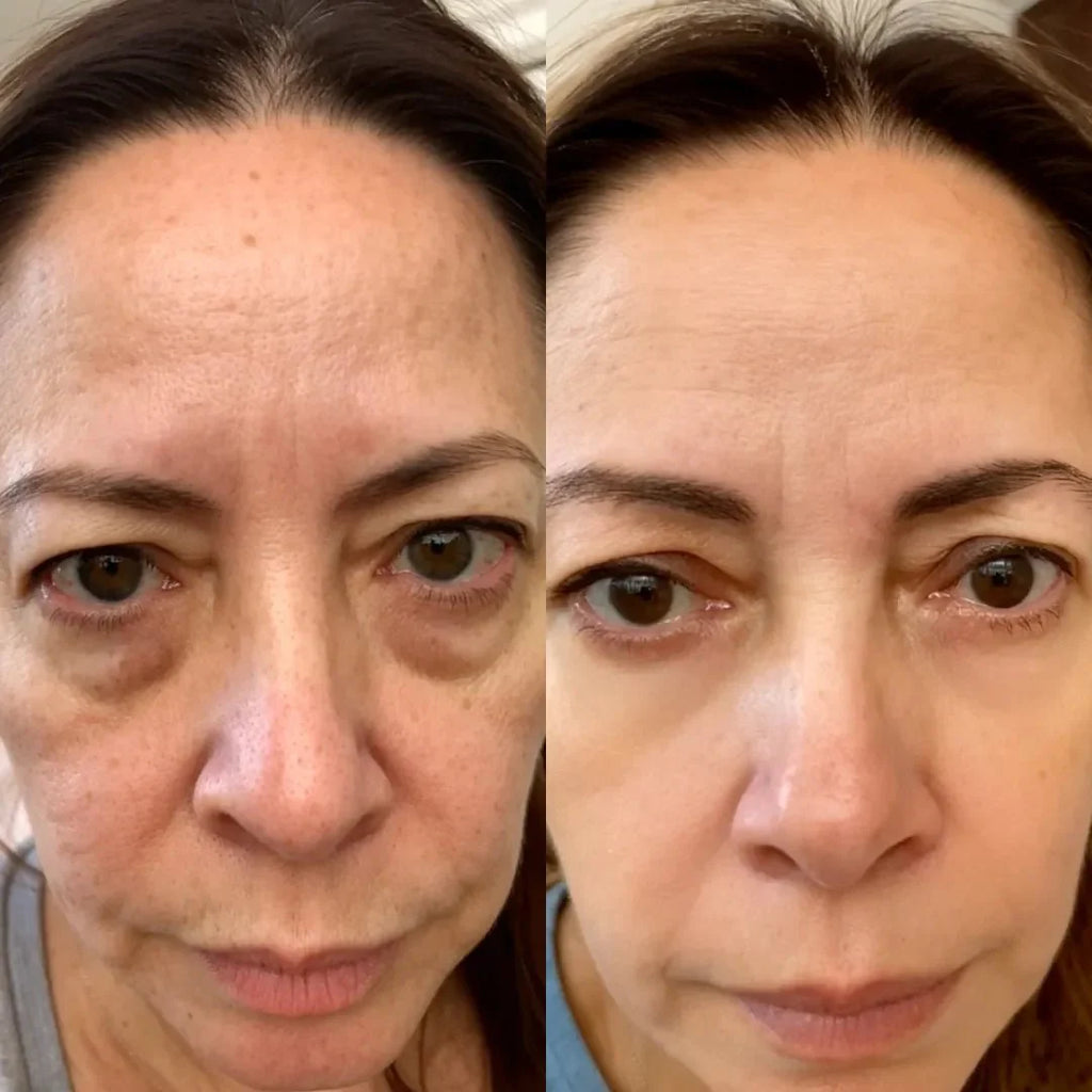 2-in-1 Red Light Therapy + EMS To Erase Eye Bags