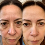 2-in-1 Red Light Therapy + EMS To Erase Eye Bags