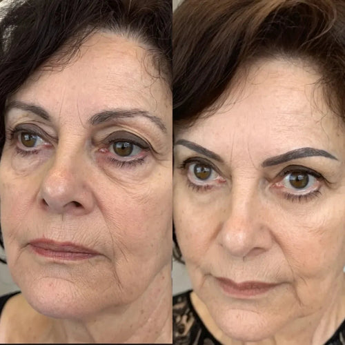 2-in-1 Red Light Therapy + EMS To Erase Eye Bags